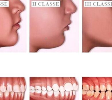 Studio Dentistico Lucaferri - Casi Di Malocclusione