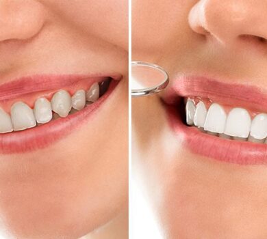 Studio Dentistico Lucaferri - Sbiancamento Dentale