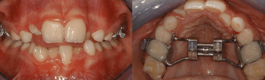 Espansore Rapido Palatale