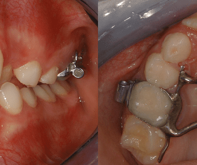 Espansore Rapido Palatale
