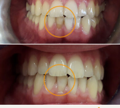 Sbiancamento Dentale