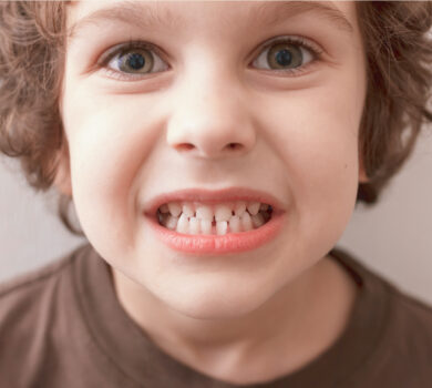 Morso Crociato - Studio Dentistico Lucaferri