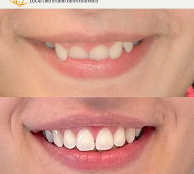 Morso Profondo - Studio Dentistico Lucaferri