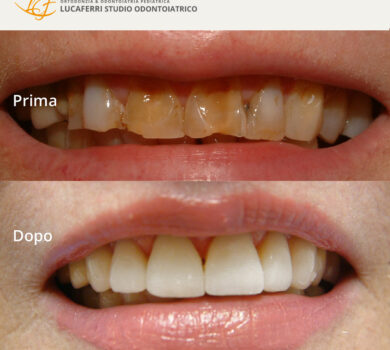 Faccette - Studio Dentistico Lucaferri
