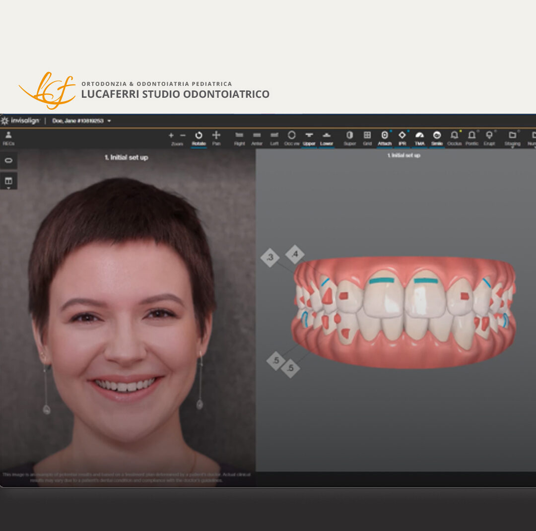 Efficacia Invisalign - Studio Dentistico Lucaferri