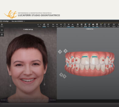 Efficacia Invisalign - Studio Dentistico Lucaferri
