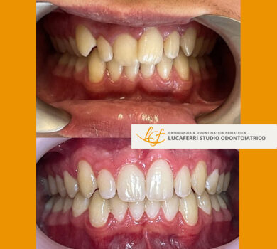 Invisalign Prima E Dopo - Studio Dentistico Lucaferri